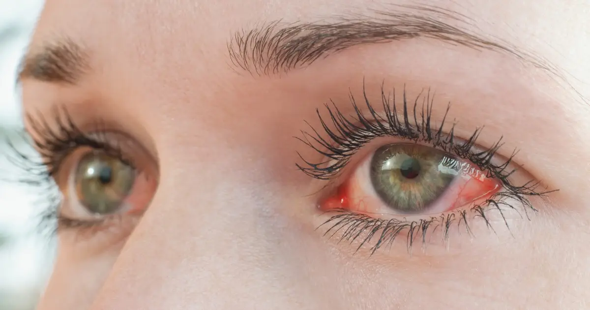 Gotas Oftálmicas para Ojos Rojos, Enrojecimiento Ocular